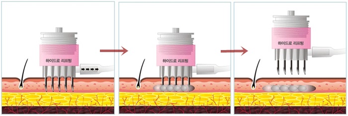 한겨울 피부보습유지로 동안피부만들기-신촌차앤박피부과- 관련 이미지 2