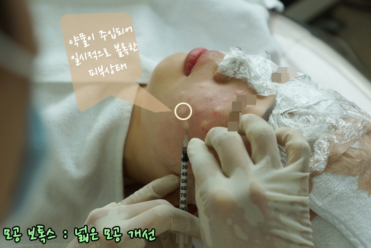 [공유] 남는 것은 사진! 활짝 웃어 보세요~ 뉴테라 리프팅으로 피부 탄력, 넓은 모공 개선하기! 관련 이미지 7