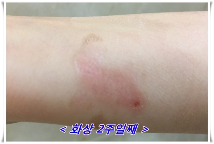 화상물집, 화상치료, 화상흉터를 최소로 남길 수 있는 방법 신촌차앤박에서 알려드릴께요!! 관련 이미지 6
