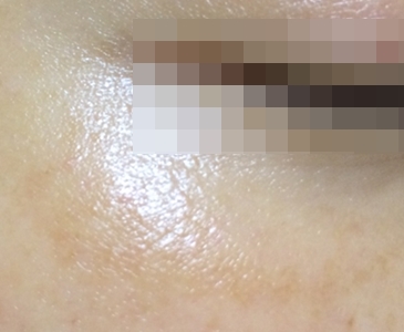 [공유] 가을은 화이트닝의 계절, 여름내 진해진 기미 치료를 위한 방법을 찾아보자! 관련 이미지 1