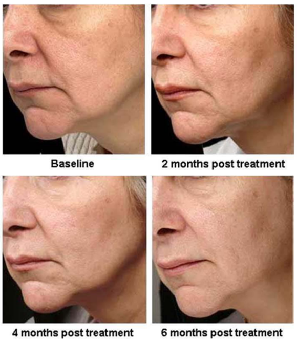 Mokdong Thermage: Is It Effective Enough to Justify the High Price? Let’s Look at the Research image 4