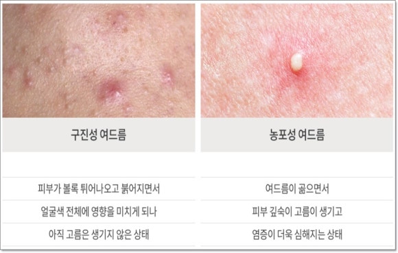 Yangcheon-gu Acne Treatment: What Are the Customized Strategies by Type? image 4