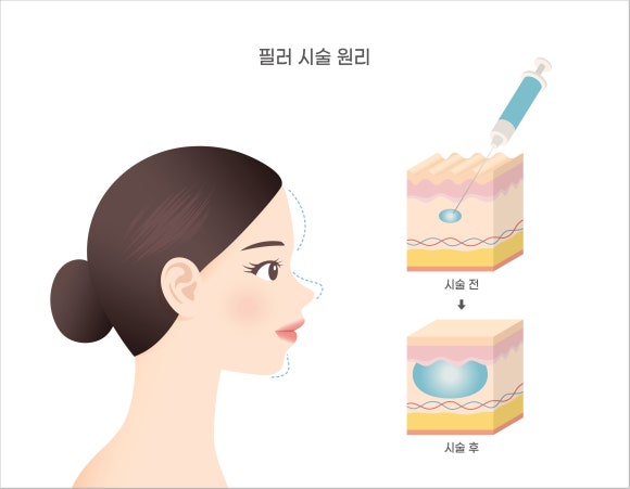 목동쥬베룩 볼륨 자연스러운 얼굴 라인을 원한다면 관련 이미지 5