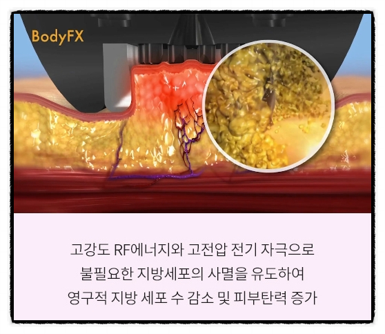A Complete Analysis of the Differences Between the Two Versions of InMode in Mok-dong <Written by a Doctor> image 5
