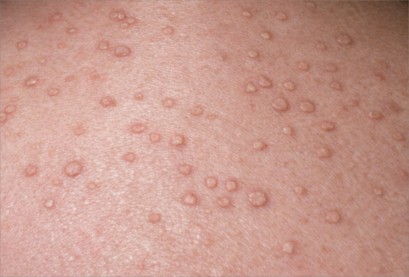 Mokdong Warts: Why You Should Check for Flat Warts If You Thought They Were Blemishes but They Keep Increasing image 1
