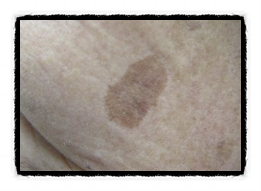 Can Yangcheon-gu dark spots be removed completely and cleanly? image 2