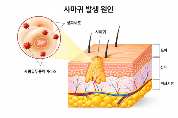 목동사마귀, 시술 전 이 부분은 꼭 확인하세요 관련 이미지 2