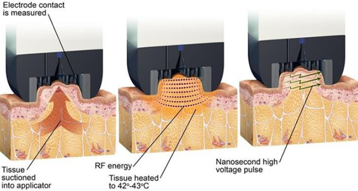 I Lost Weight, So Why Is the Cellulite Still There? <Why InMode BodyFX Is Needed> image 2