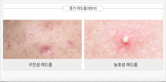 양천구여드름 흉터 남기 전에 신속하게 대응해야 하는 이유 <의사 작성> 관련 이미지 4