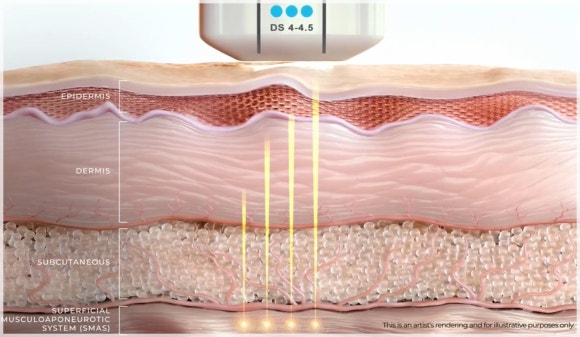 Why Is Ulthera Designated as the “Gold Standard”? Let’s Look at the Research image 2