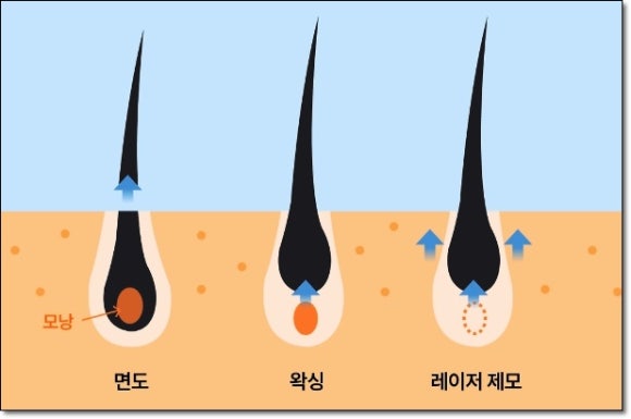 Mok-dong Underarm Hair Removal, A Complete Summary of the Pros and Cons by Hair Removal Type image 5