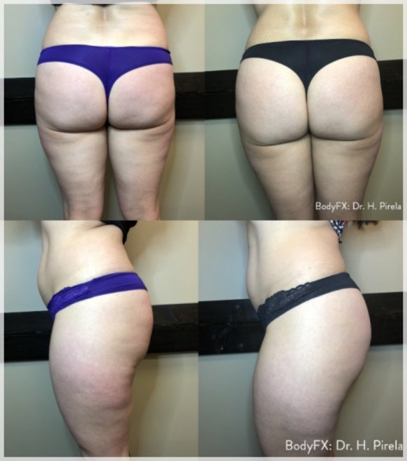 I Lost Weight, So Why Is the Cellulite Still There? <Why InMode BodyFX Is Needed> image 5
