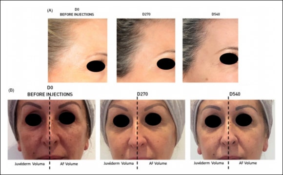Filler Effects by Area? This Was the Best Spot [Paper Attached] image 6