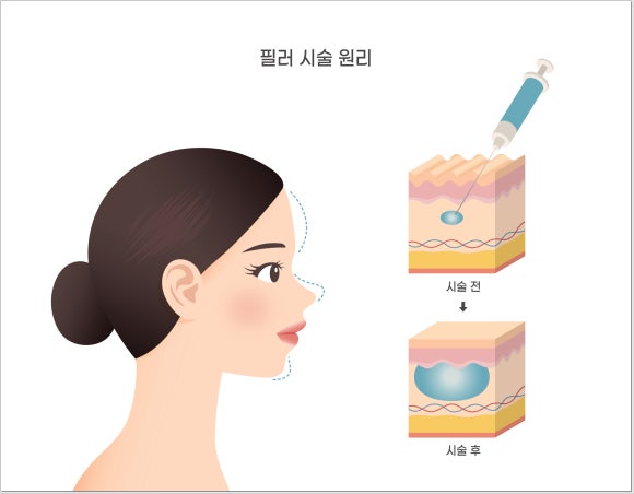 Omokgyo Filler: If wrinkles make you feel self-conscious when smiling image 3