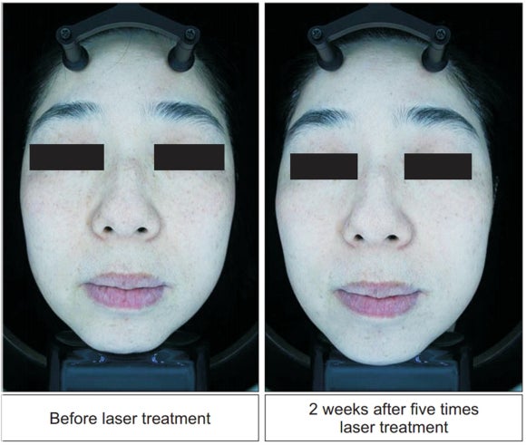 Can Melasma Be Treated with Pico Toning and PicoCare Majesty? [Paper Comparing 2 Methods Attached] image 4