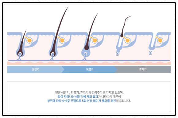 What Determines the Number of Mokdong Laser Hair Removal Sessions? <Written by a Doctor> image 2