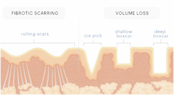 Understanding the Principles of Scar Treatment Through Research on Mokdong Juvelook image 2