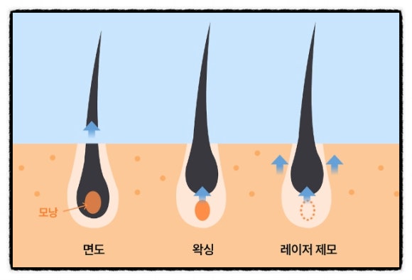 양천구레이저제모 관련 자주 묻는 질문들 <의사 답변> 관련 이미지 4