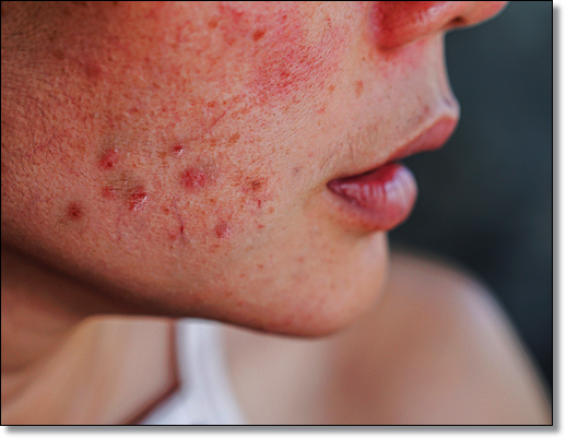 Yangcheon-gu Acne Treatment: What Are the Customized Strategies by Type? image 7