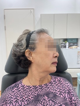 When Fillers Alone Aren’t Enough: Mokdong Thread Lifting image 5