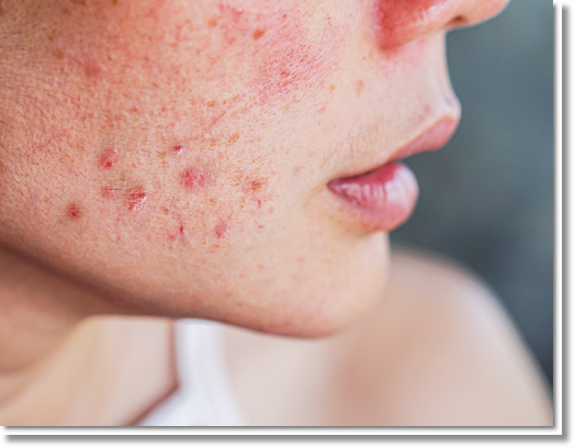 Yangcheon-gu Acne Treatment: If You’re Tired of Repeated Breakouts, Read This. image 6