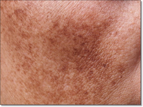 What You Must Know Before Getting Myeongdong Picotoning Treatment image 4