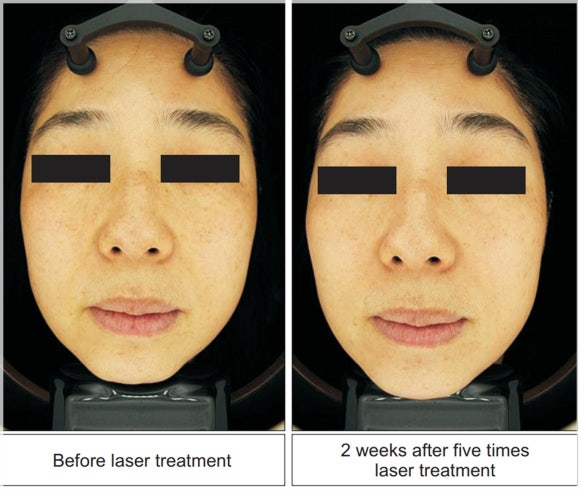 Can Melasma Be Treated with Pico Toning and PicoCare Majesty? [Paper Comparing 2 Methods Attached] image 6