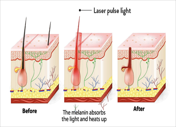 Why Laser Hair Removal in Yangcheon-gu Can’t Be Done All at Once and the Points You Should Check image 2