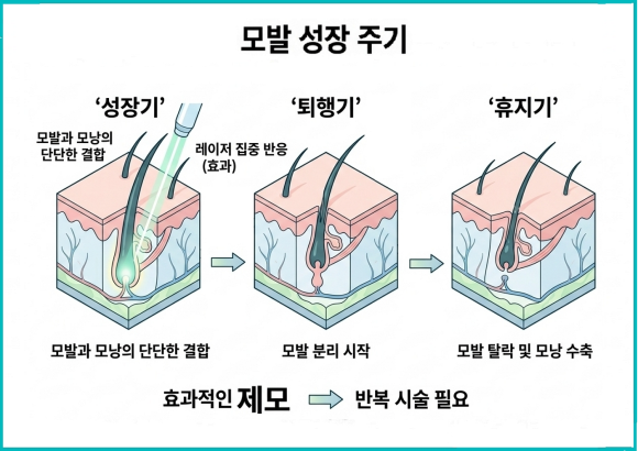 Yangcheon-gu Laser Hair Removal: What Critical Factor Makes the Difference in Satisfaction? image 2