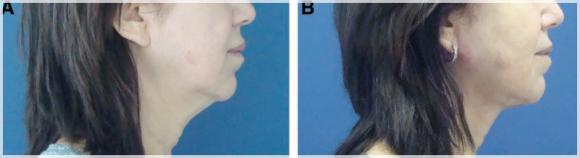 Looking Into Mokdong InMode Lifting Results? We’ll Explain With Objective Journal Data image 6