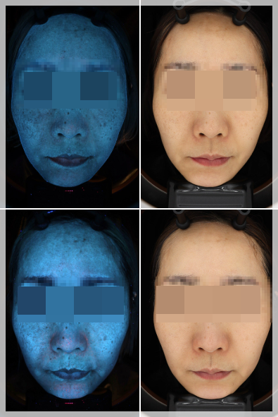 Mokdong Pico Toning: Concerned About Blemishes and a Dull Skin Tone? image 5