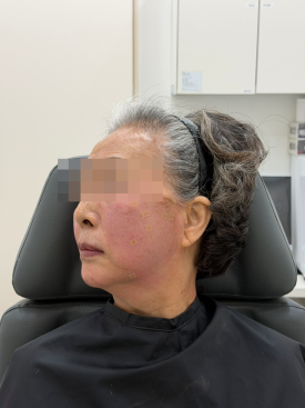 When Fillers Alone Aren’t Enough: Mokdong Thread Lifting image 10