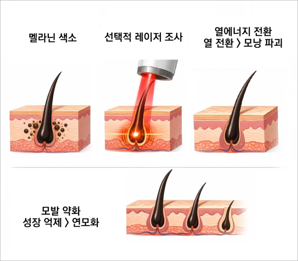 오목교레이저제모 부작용 생길까봐 걱정되신다면 관련 이미지 2