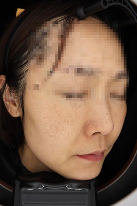 목동 레이저토닝 기미 주근깨 치료 제대로 하려면 관련 이미지 9