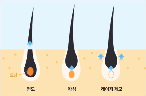 목동레이저제모 남자 수염에도 효과가 좋을까? 관련 이미지 2