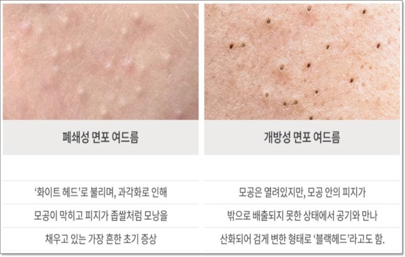 Yangcheon-gu Acne Treatment: What Are the Customized Strategies by Type? image 3