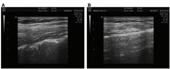 Looking Into Mokdong InMode Lifting Results? We’ll Explain With Objective Journal Data image 4