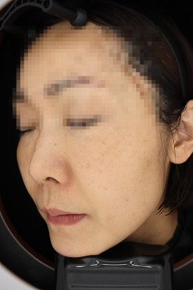 목동 레이저토닝 기미 주근깨 치료 제대로 하려면 관련 이미지 11