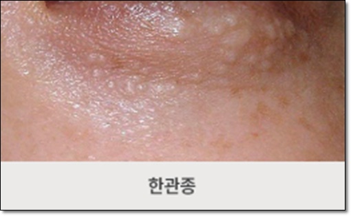 목동비립종, 얼굴에 올라온 하얀 점들 깨끗이 제거하려면? 관련 이미지 3