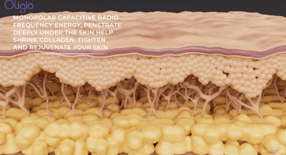 Yangcheon-gu Oligio: Is It Really the Ultimate Cost-Effective Lifting Treatment? image 2