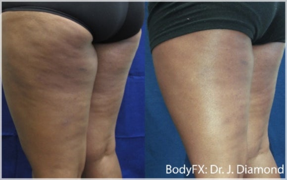 I Lost Weight, So Why Is the Cellulite Still There? <Why InMode BodyFX Is Needed> image 7