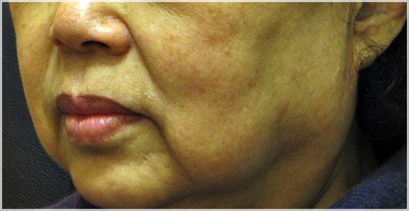 Mokdong Thermage: Is It Effective Enough to Justify the High Price? Let’s Look at the Research image 6