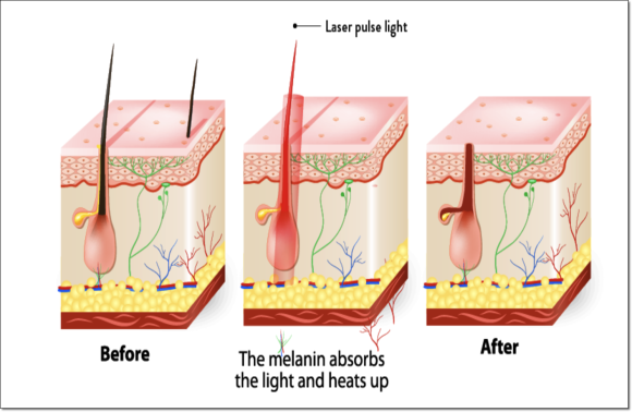 Mokdong Laser Hair Removal: What If Frequent Shaving and Waxing Have Made Your Skin Sensitive? image 2