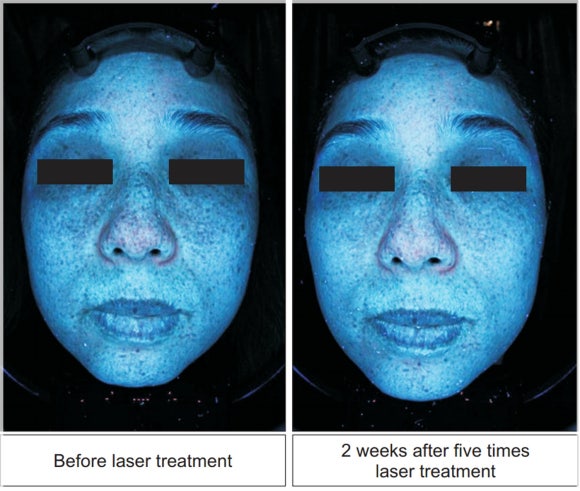 Can Melasma Be Treated with Pico Toning and PicoCare Majesty? [Paper Comparing 2 Methods Attached] image 5