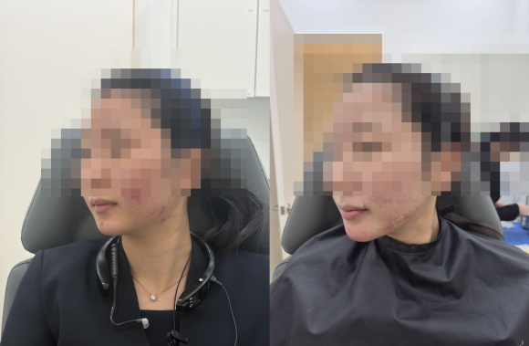 If You’re Looking for a Way to Enhance the Jawline with Mokdong Filler image 5