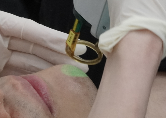 Why Mokdong Laser Hair Removal Can Reduce Irritation image 2