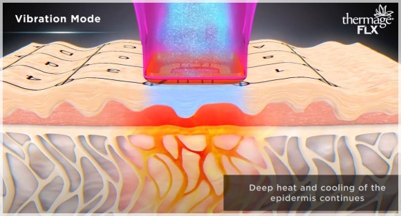 If Comparing Mok-dong Ulthera with Radiofrequency Lifting Like Thermage image 6