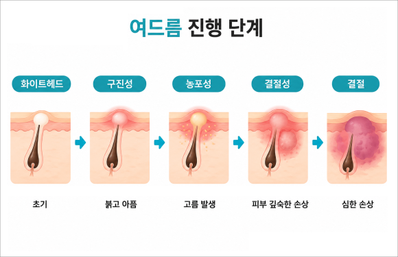 Yangcheon-gu Acne Treatment, How Can You Avoid Scarring? image 3