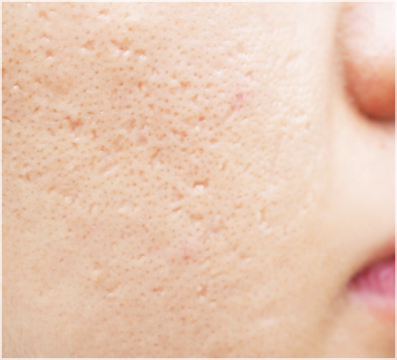 Understanding the Principles of Scar Treatment Through Research on Mokdong Juvelook image 1