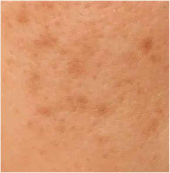 목동 레이저토닝, 기미와 잡티가 반복된다면 관련 이미지 4